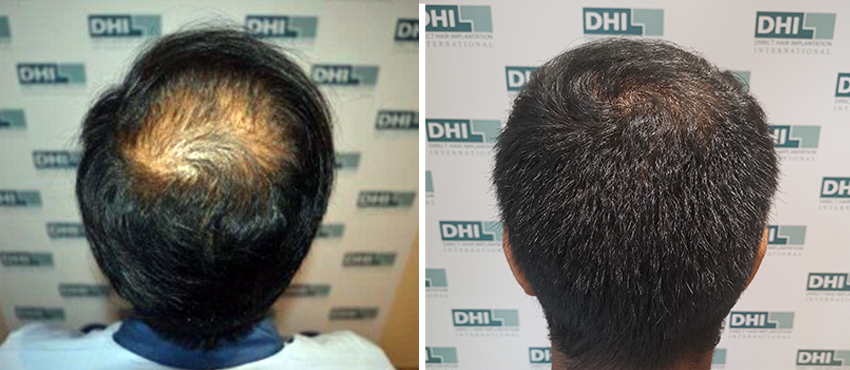 DHI before & after hair transplant results